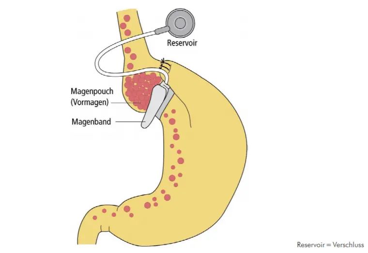 Magenband