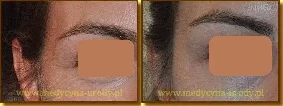 Botox Kossut