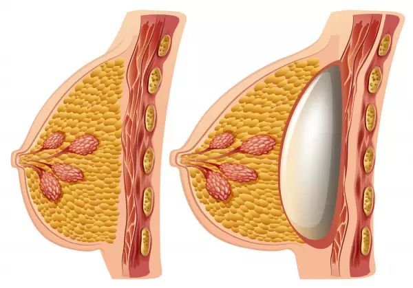 uložení prsního implantátu při zvětšení