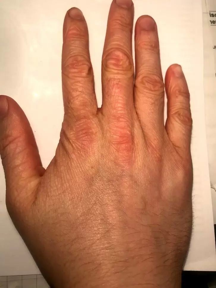 Faltige Hände mit 20 wegen Neurodermitis Injizierbare Füllstoffe Dysport, Restylane, Botox