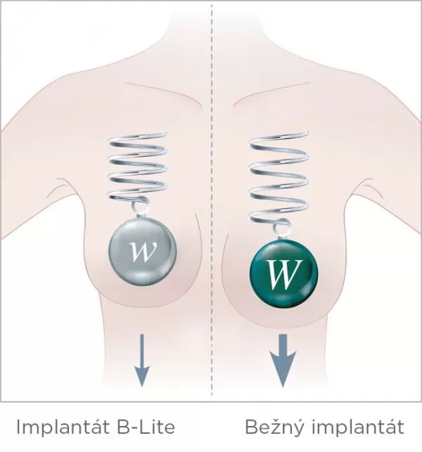 porovnanie B Lite a štandardného implantátu