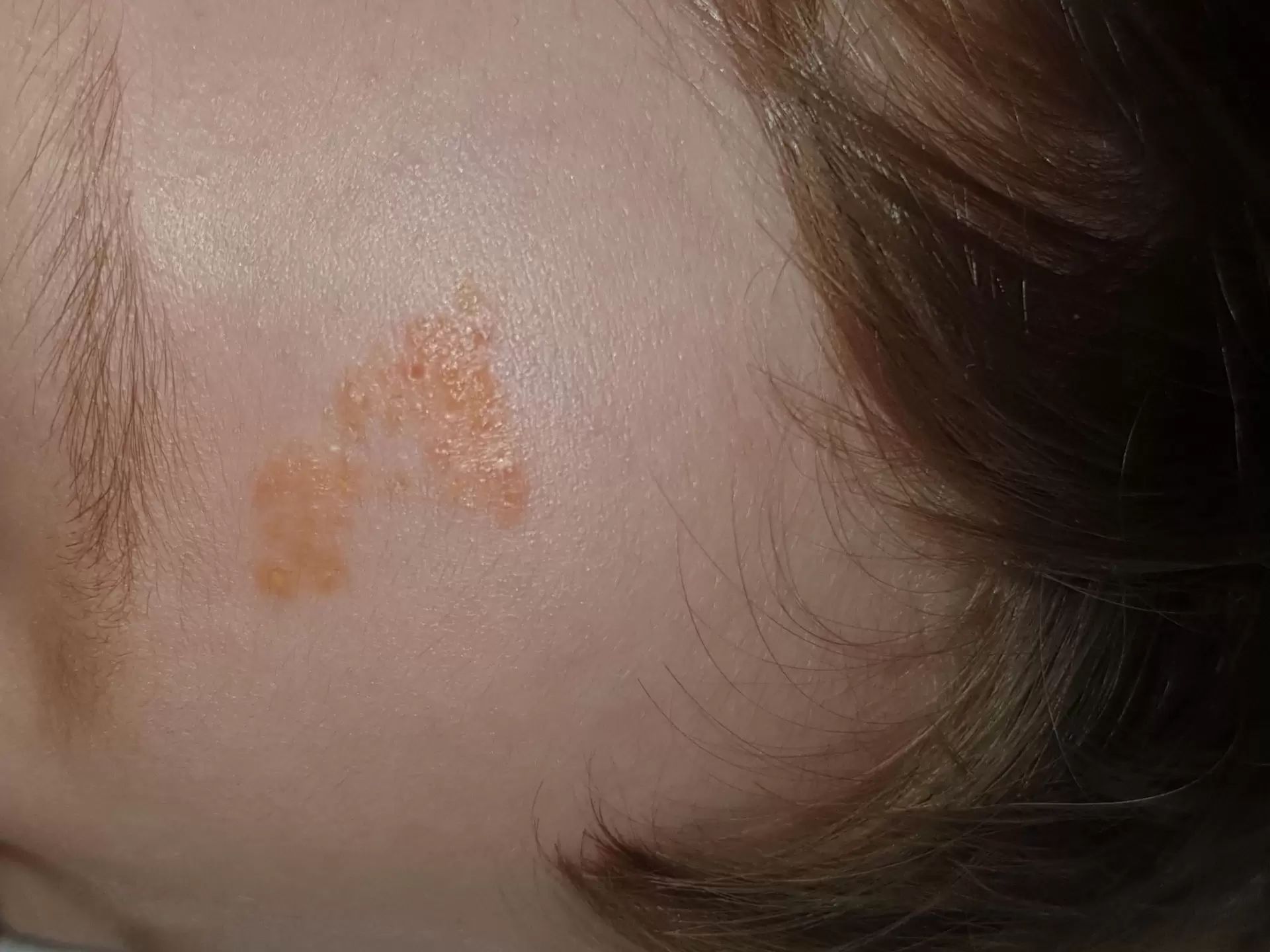 Nevus Sebaceus