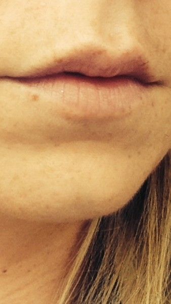 Extreme Schwellung Nach Lippen Aufspritzen Injizierbare Fullstoffe Dysport Restylane Botox Bio Alcamid Forum Estheticon De