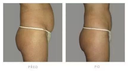 fotky před a po SlimLipo laserové liposukci