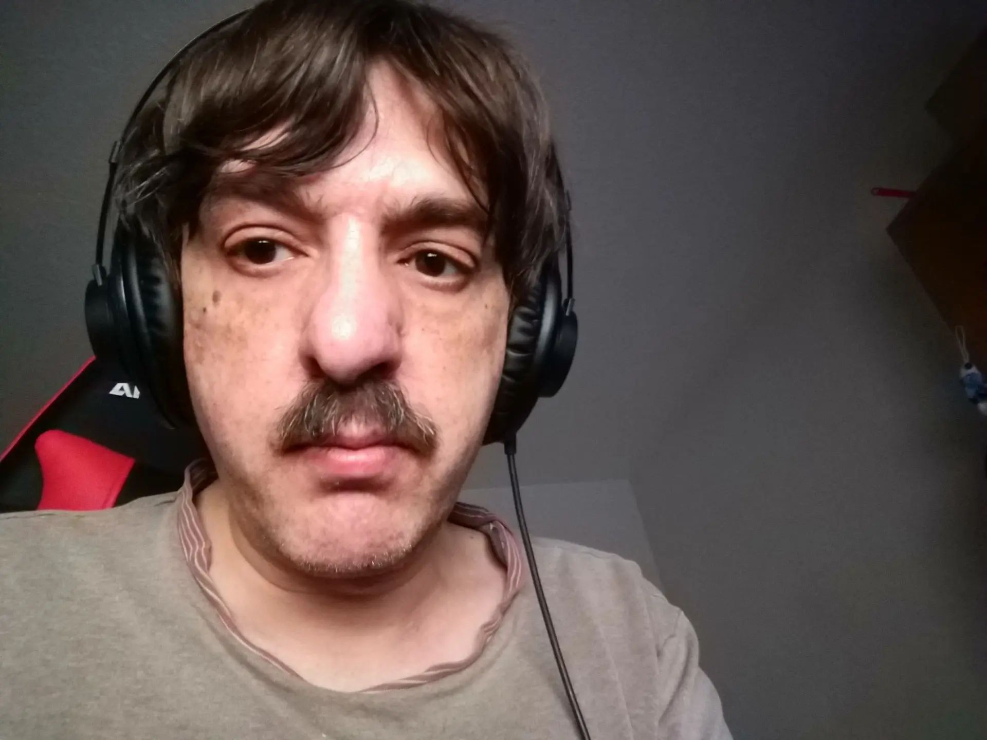Schiefe Nase Rechten Nasenbein Knochen Fehlt Geburts Fehler Nasenkorrektur Rhinoplastik Forum Estheticon De