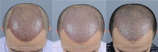 Haartransplantation post op verlauf