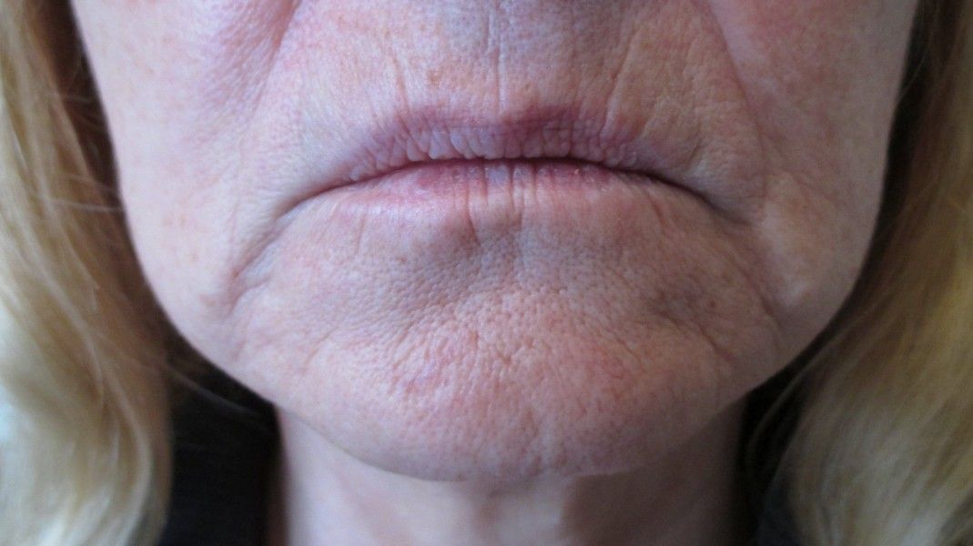 Unterspritzung Der Lippenfaltchen Und Nasolabialfalten Injizierbare Fullstoffe Dysport Restylane Botox Bio Alcamid Forum Estheticon De