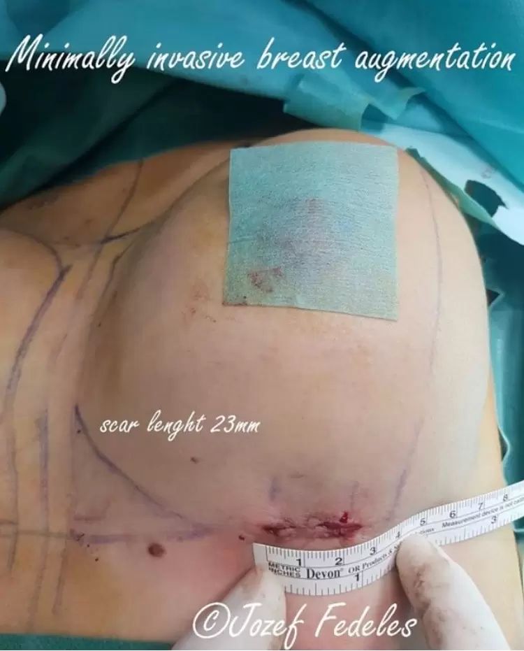 zväčšenie prsníkov s malou jazvou a implantáty Motiva