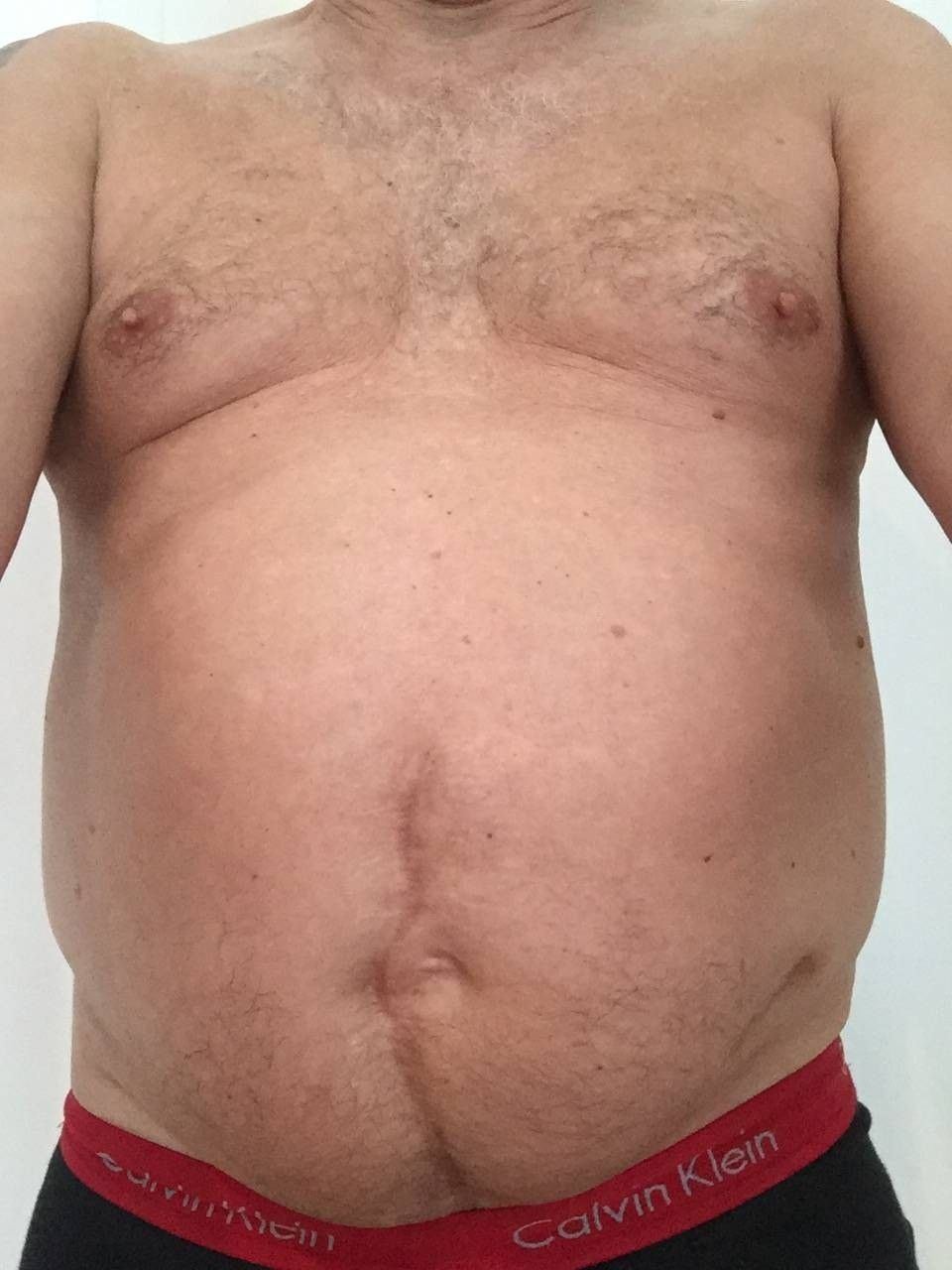 Erfolglose Bauchstraffung Und Fettabsaugung Von 500 G Beim Mannerbauch Estheticon De