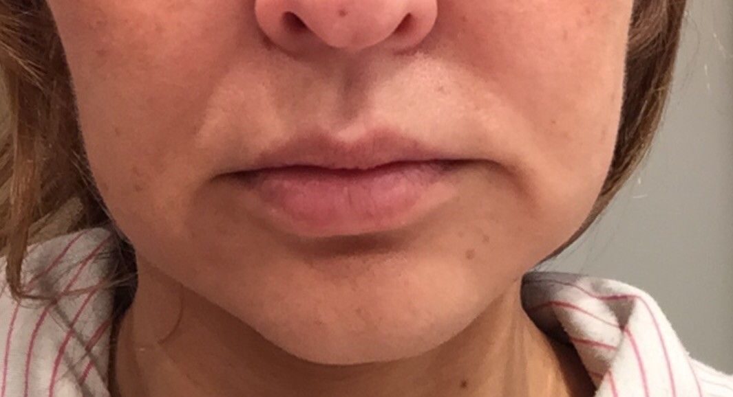 Marionettenfalten Nach Hyaluronbehandlung Injizierbare Fullstoffe Dysport Restylane Botox Bio Alcamid Forum Estheticon De