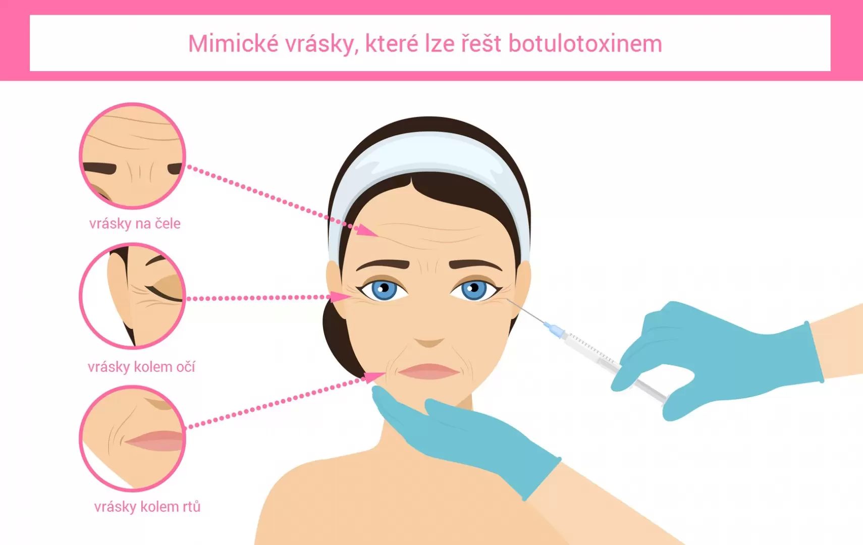 jak vrásky odstraní botulotoxin? vrásky kolem očí, vrásky na čele, vrásky kolem rtů
