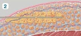 liposukce4