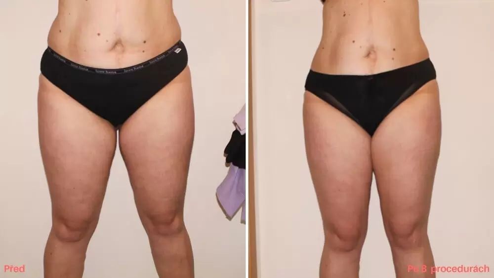 neinvazivní liposukce břicha