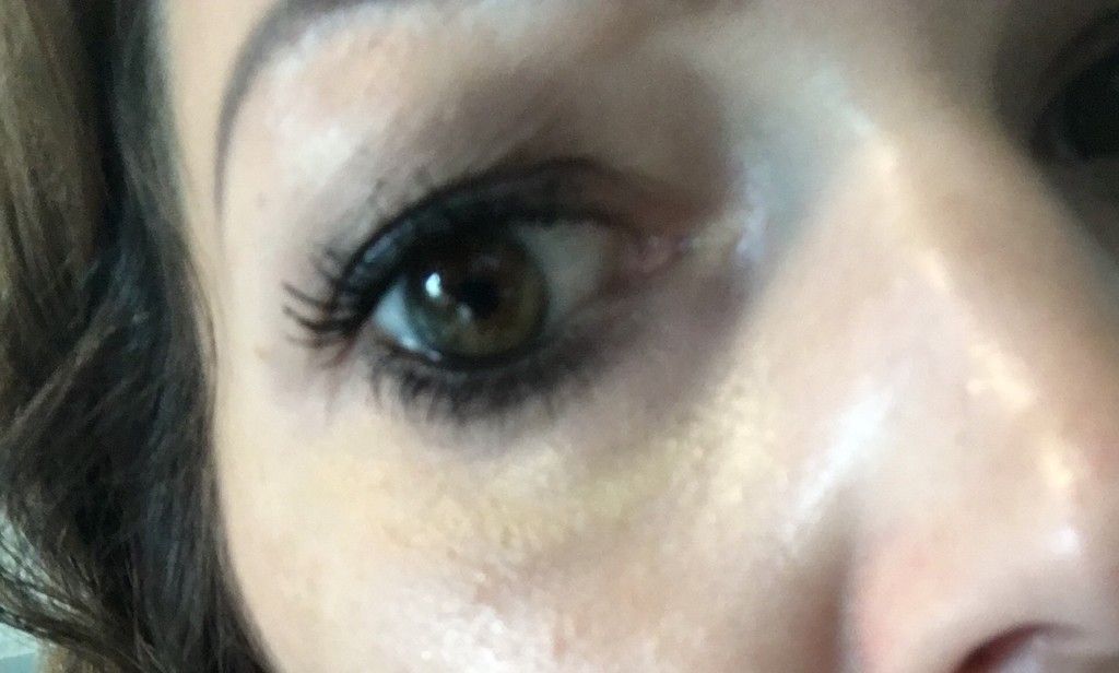 Wulst Unterm Auge Nach Uber 1 5 Jahren Von Unterpritzung Restylane Juvederm Surgiderm Teosyal Matridex Matridur Derivate Der Hyaluronsaure Forum Estheticon De