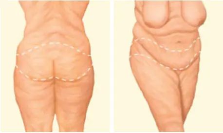 bodylift