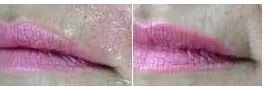 Traitement de l’affaissement des commissures labiales