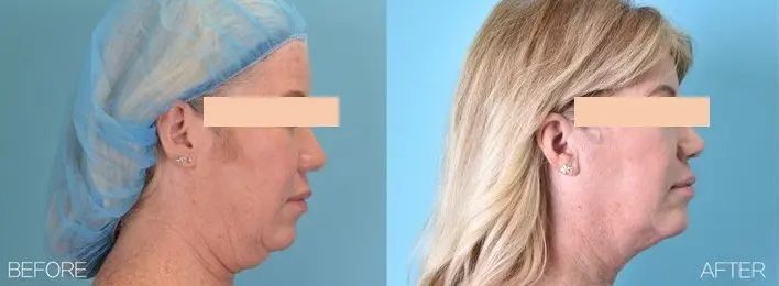 AGNES b&a Double Chin