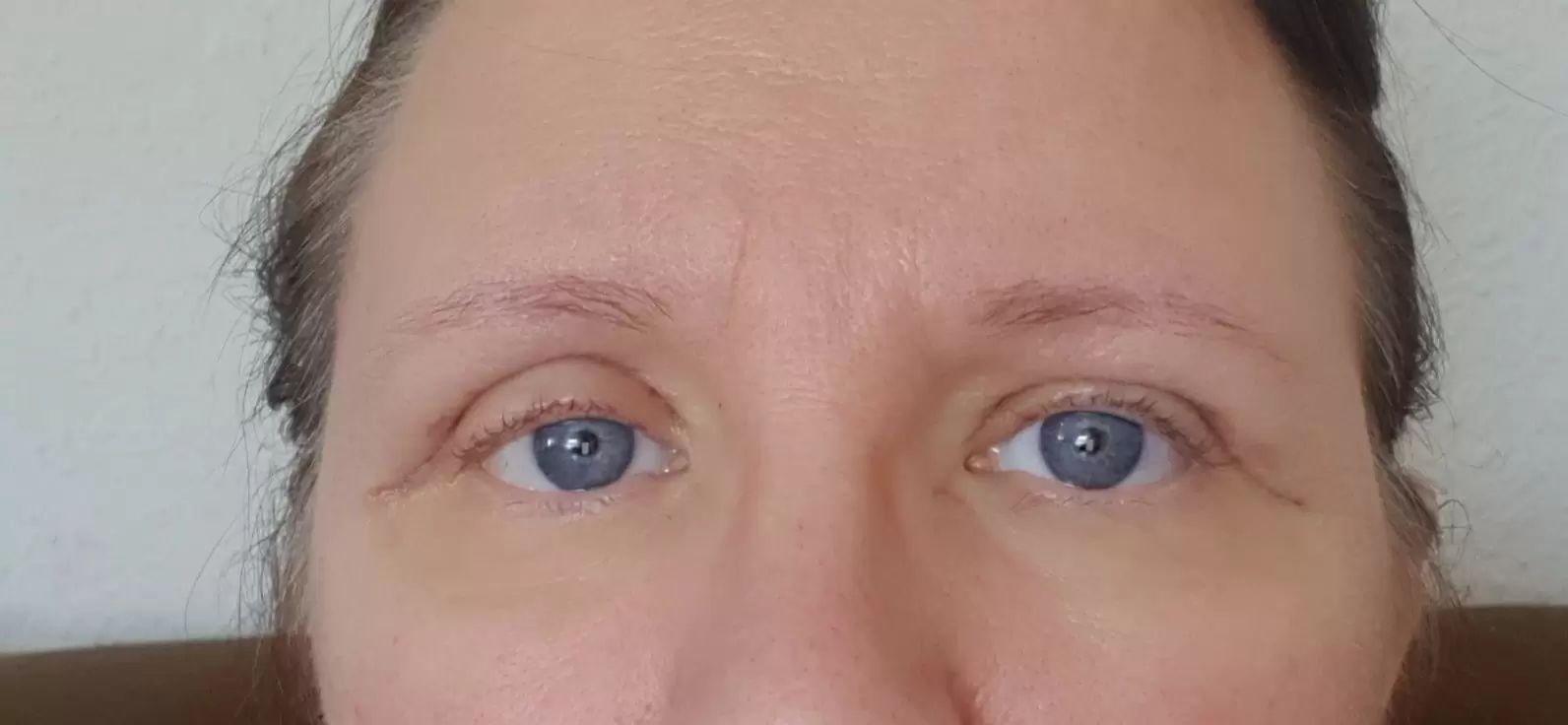 Blepharoplastik Oberlid