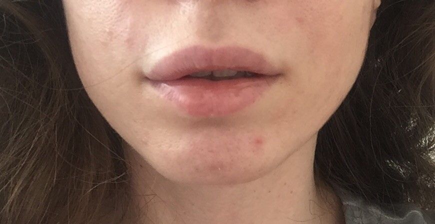 Klumpenbildung Nach Hyaluron An Den Lippen Injizierbare Fullstoffe Dysport Restylane Botox Bio Alcamid Forum Estheticon De