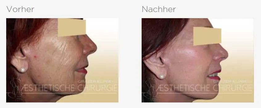 facelift