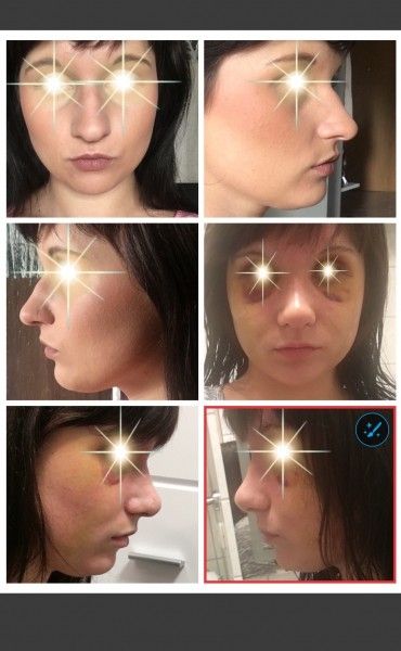 Unmoglich 14 e Nach Nasenbegradigung Verschmalerung Und Verkurzung Nasenkorrektur Rhinoplastik Forum Estheticon De