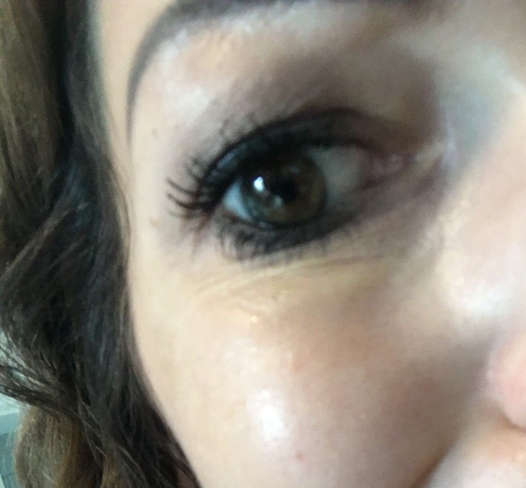 Wulst Unterm Auge Nach Uber 1 5 Jahren Von Unterpritzung Restylane Juvederm Surgiderm Teosyal Matridex Matridur Derivate Der Hyaluronsaure Forum Estheticon De