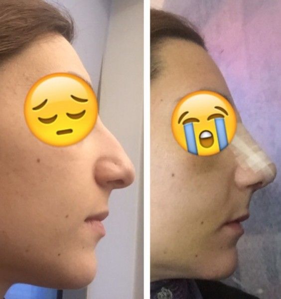 Spitze Und Angehobene Nase Und Keine Oberlippe Nach Nasenop In Der Turkei Nasenkorrektur Rhinoplastik Forum Estheticon De