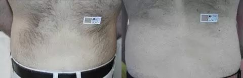 Laserová epilácia, depilácia odstránenie chĺpkov na chrbte esthetic