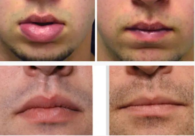 lippenverkleinerung