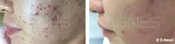 b&a acne