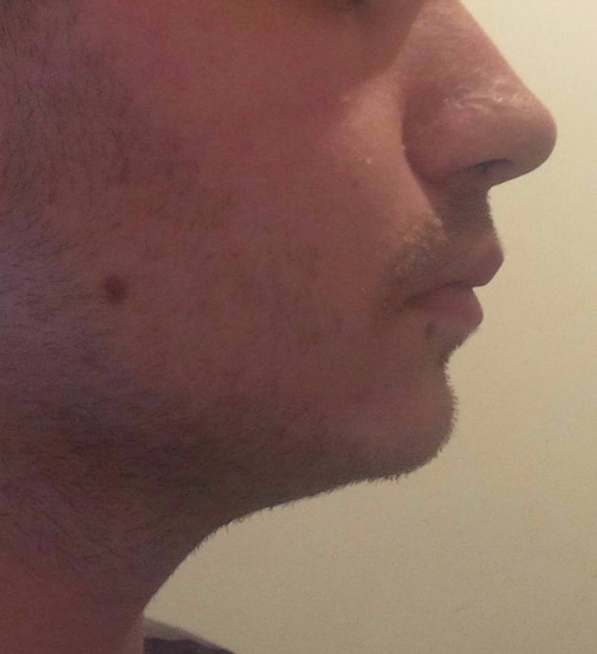 Rhinoplastie Je N Aime Pas Mon Profil Comment L Ameliorer Rhinoplastie Chirurgie Du Nez Forum Estheticon Fr