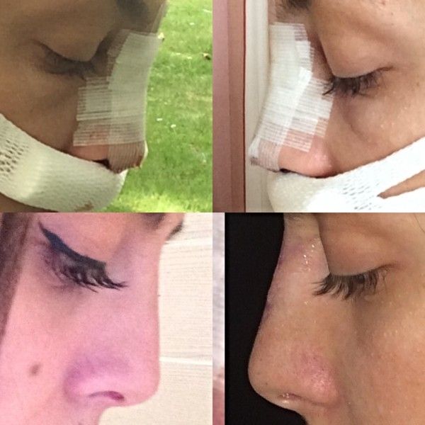 Form Der Nase Durch Schwellung Geandert Nasenkorrektur Rhinoplastik Forum Estheticon De