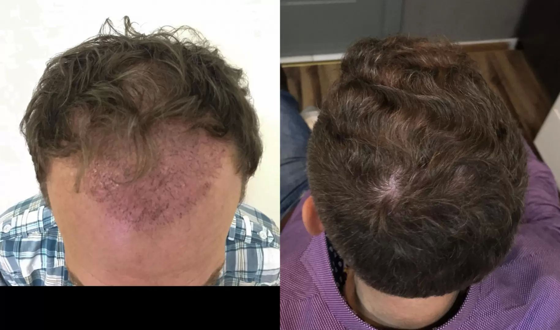 Przeszczep wlosow FUE Turkowski