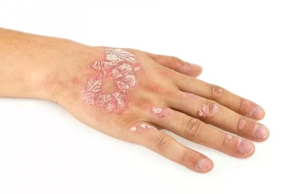 lupénka (psoriaza)