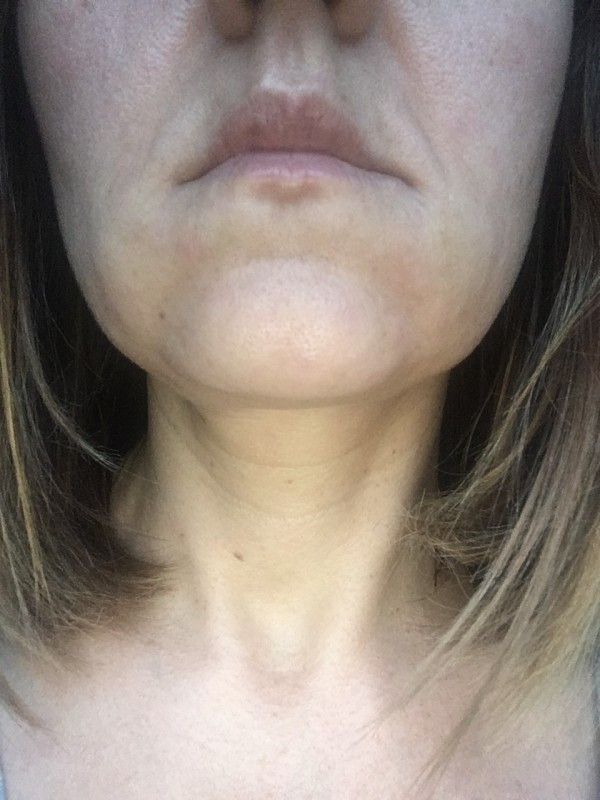 Schwellungen In Den Unteren Backen Nach Unterspritzung Der Mundwinkelfalten Injizierbare Fullstoffe Dysport Restylane Botox Bio Alcamid Forum Estheticon De