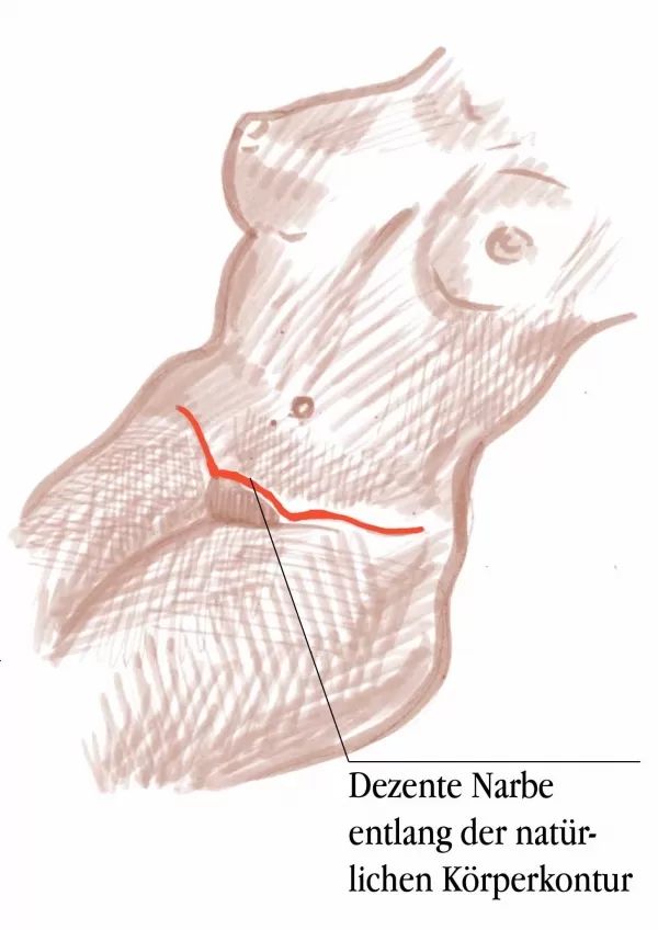 Narbe nach Bauchdeckenstraffung