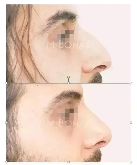 Rhinoplastika
