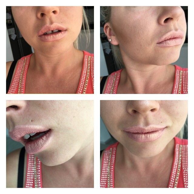 Wie Viel Hyaluron Fur Recht Volle Lippen Lippenvergrosserung Mit Hyaluronsaure Forum Estheticon De