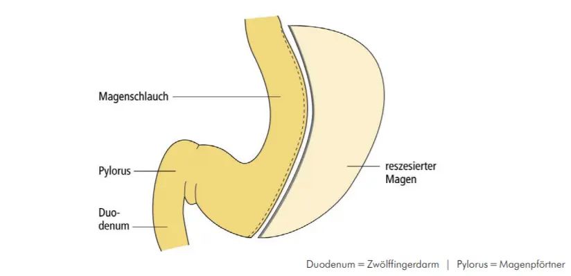 magenschlauch