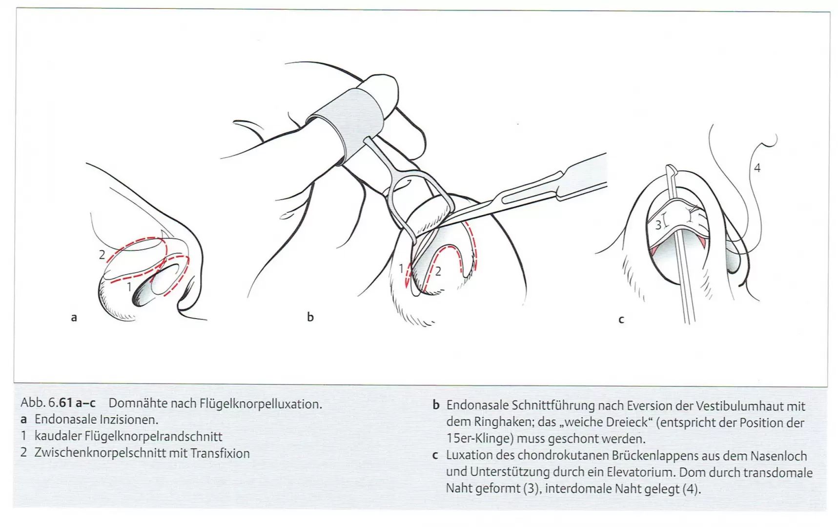 Schema Nasenspitzenkorrektur mit endonasalem Zugang