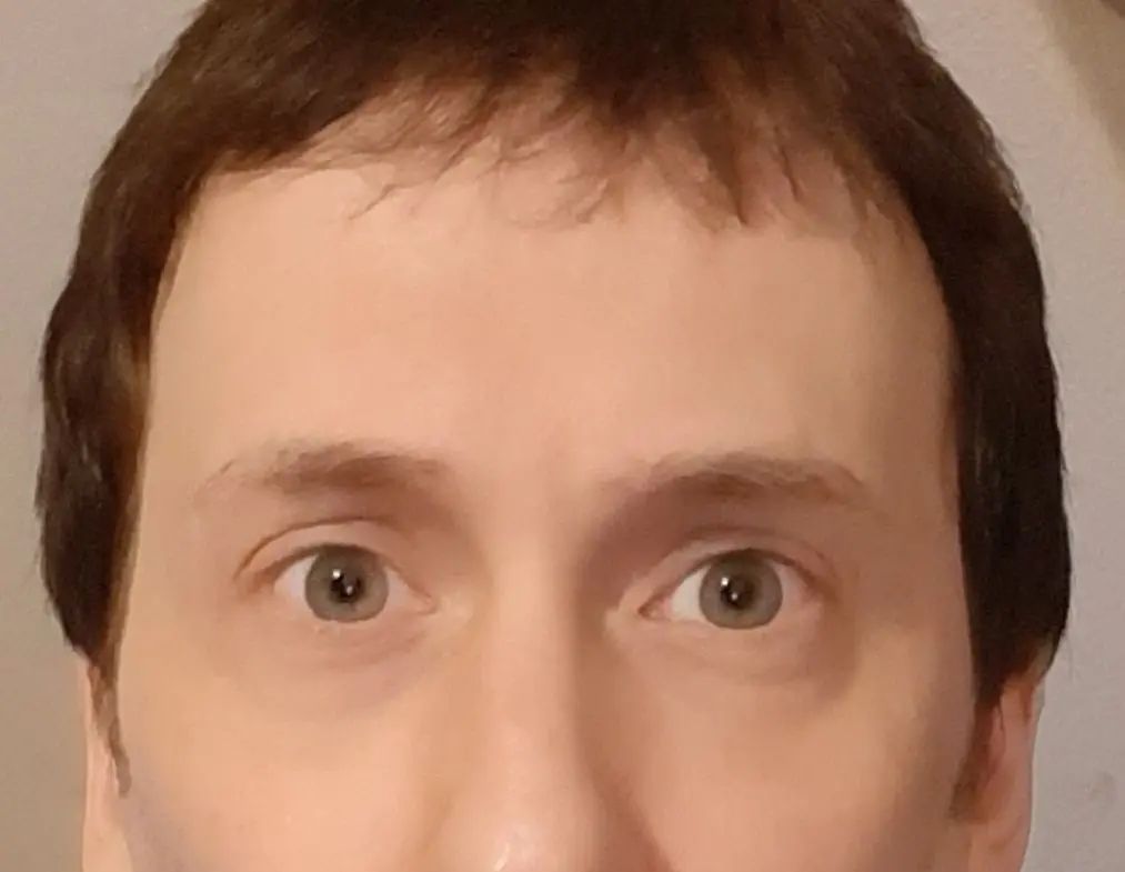 Les Yeux En Bas A Droite Snap Asymétrie au niveau des yeux. - Opération des paupières supérieures