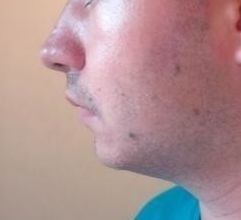 Rhinoplastie Je N Aime Pas Mon Profil Comment L Ameliorer Rhinoplastie Chirurgie Du Nez Forum Estheticon Fr