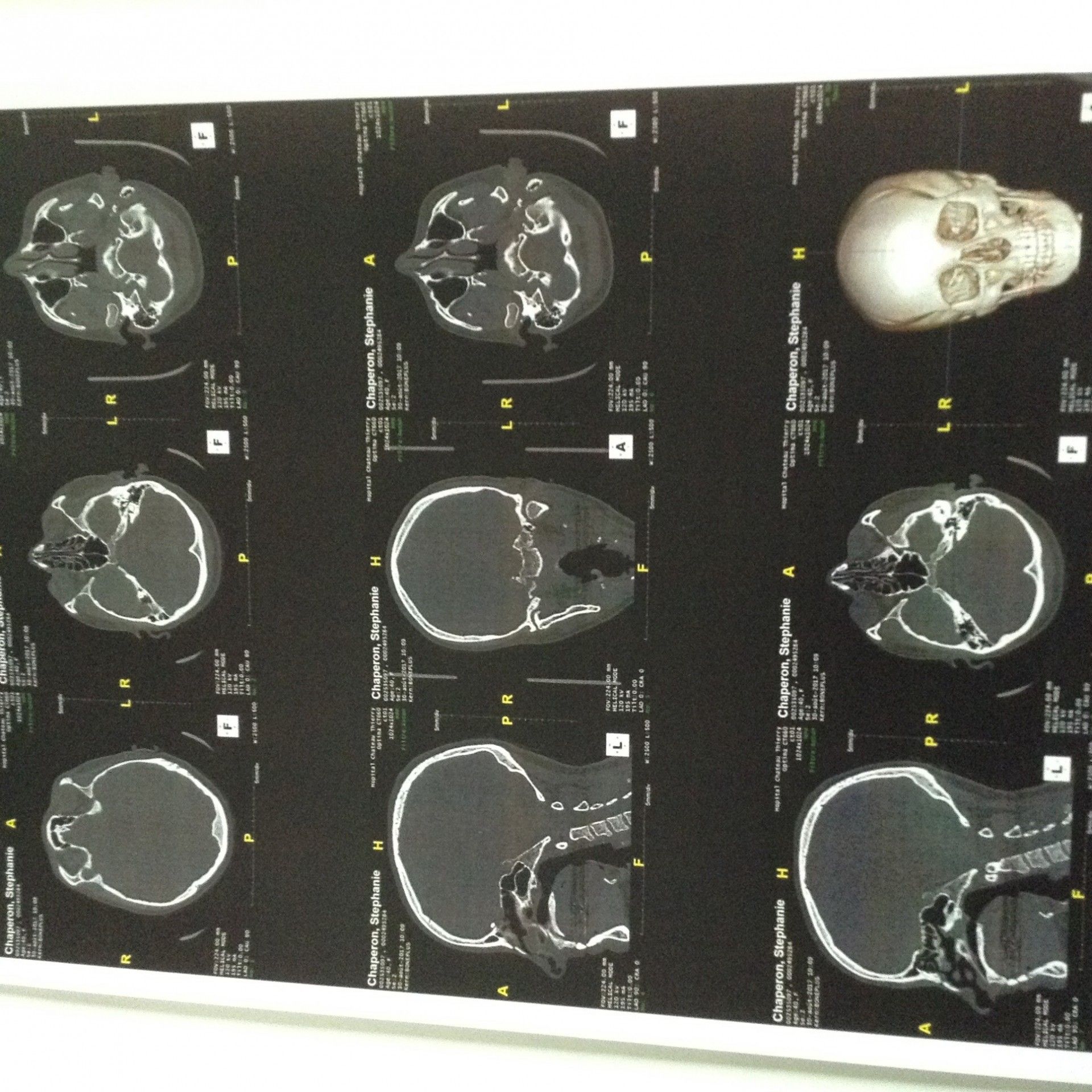 Hypertrophie des suite à rhinoplastie il y a six mois Rhinoplastie (chirurgie du nez