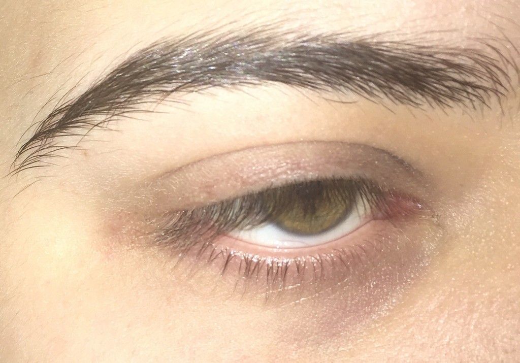 Operative Behandlungsmöglichkeiten von Eyelash Ptosis in Deutschland