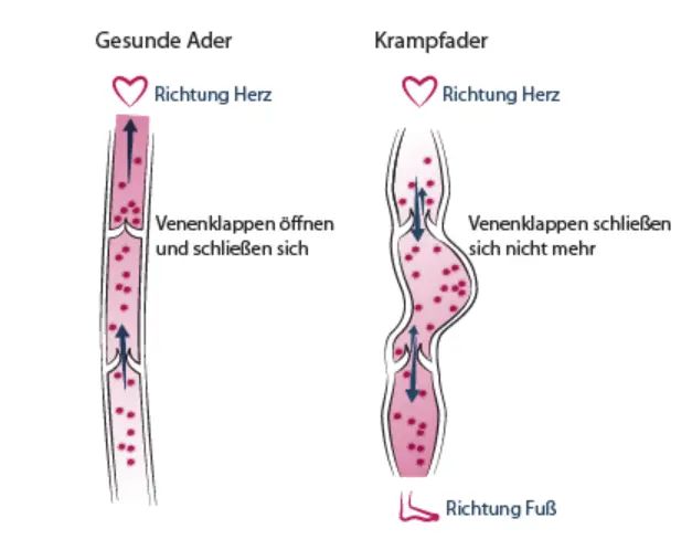krampfader