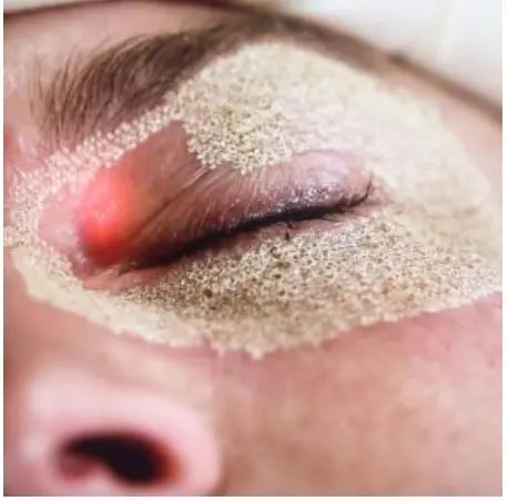 laser fraktional