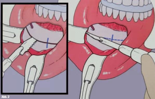 genioplastik2