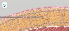 liposukce5