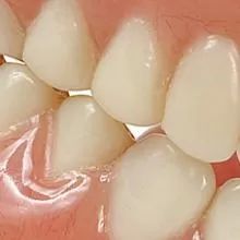 implant