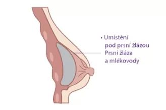 vložení prsního implantátu pod prsní žlázu